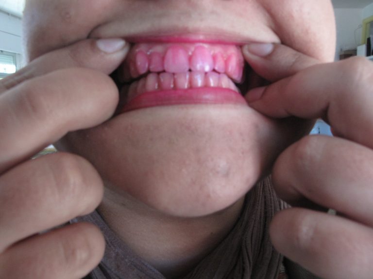 Dientes: limpieza